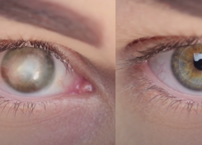 antes-depois_implante-695x500.png