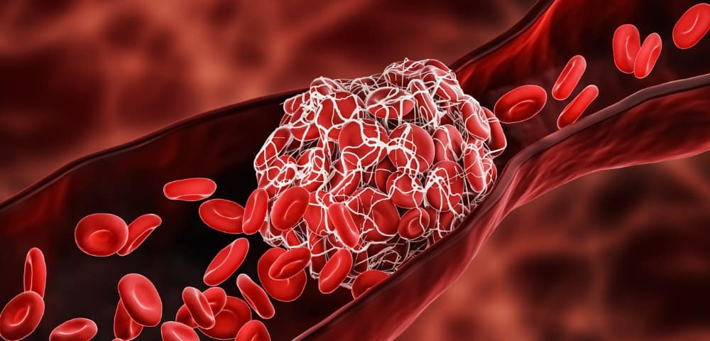 blood-clot-or-thrombus-blocking-the-red-blood-cells-stream-within-an-picture-id1297034329