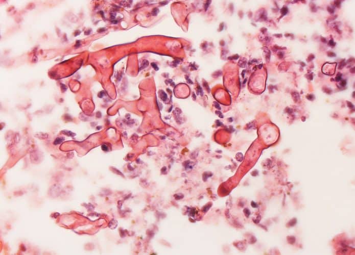 mucormicose