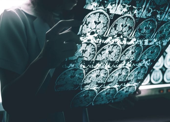 Alzheimer. Imagem: Shutter-e-Atthapon