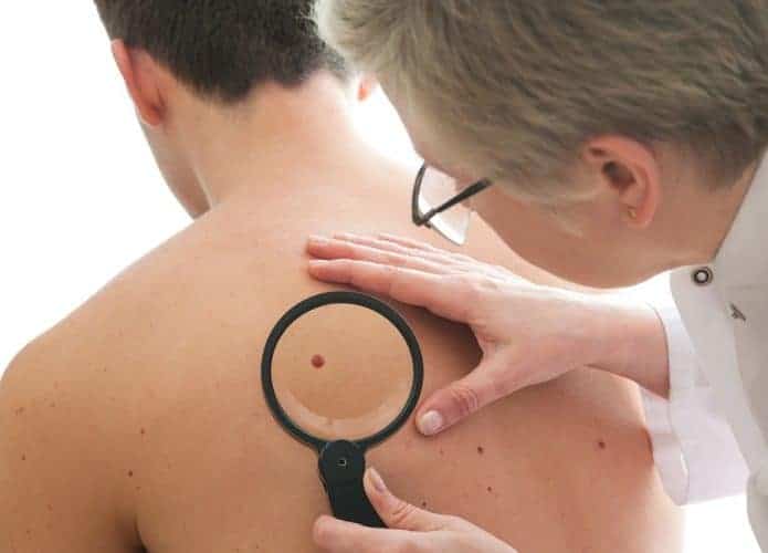 Câncer de pele em homens. Imagem: Alexander Raths/iStock
