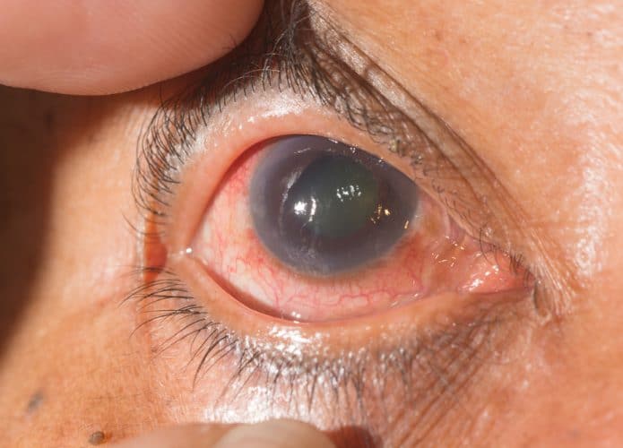 Olho com glaucoma