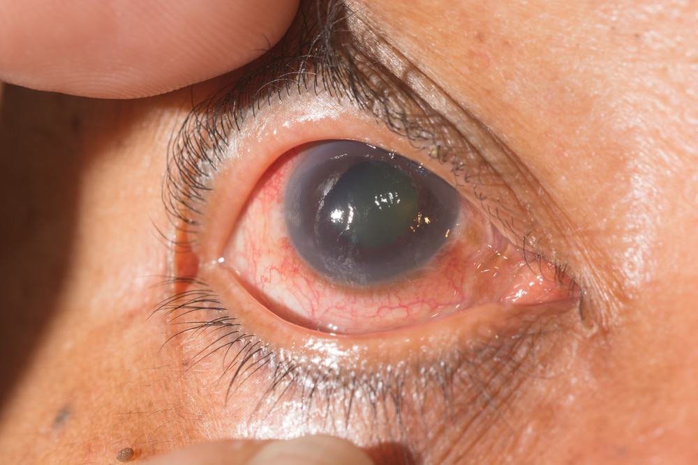 Olho com glaucoma