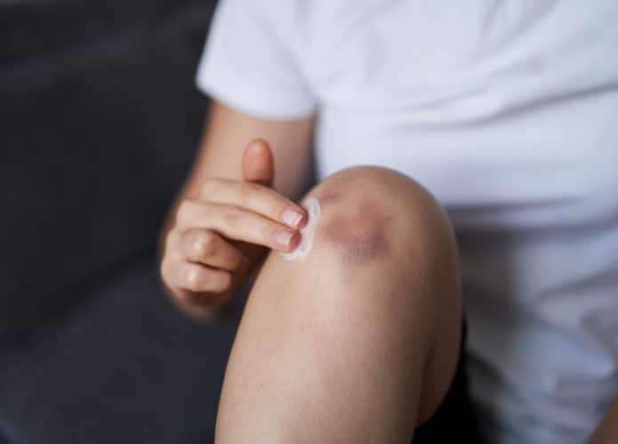 hematoma-695x500
