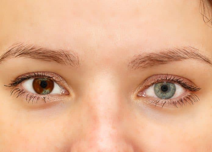 Heterocromia-695x500
