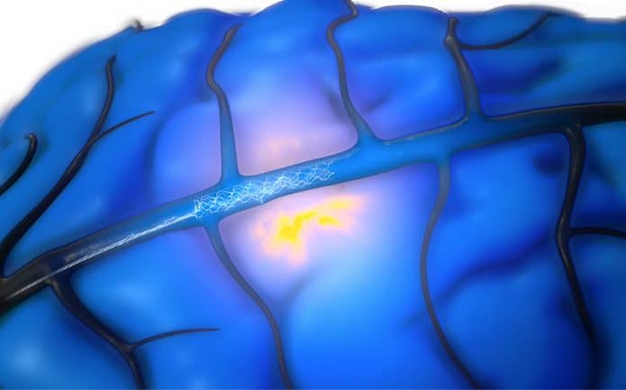 Implante cerebral Stentrode