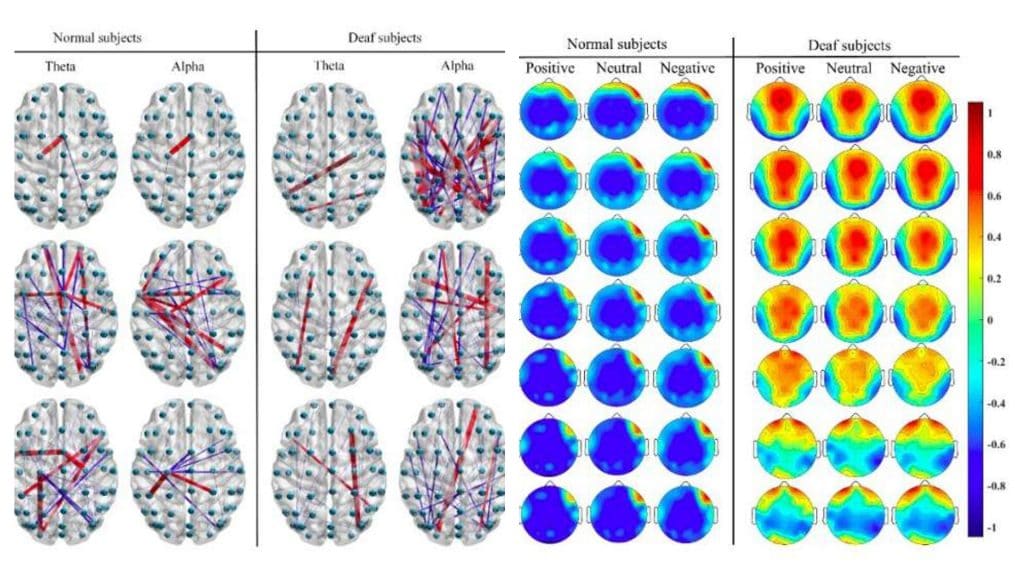 Gráficos comparam a atividade cerebral de pessoas com audição normal no reconhecimento de emoções, comparando-a com pessoas surdas
