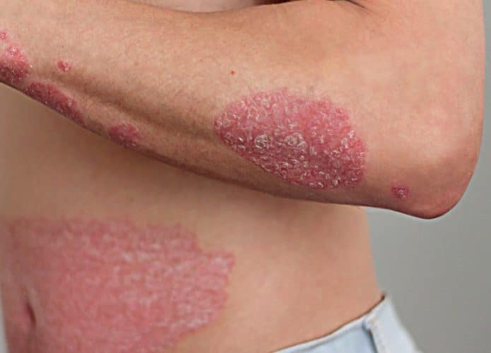 psoriase-1-695x500