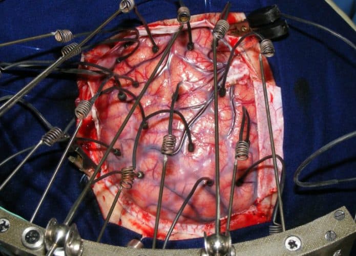 cirurgia-no-cerebro-695x500