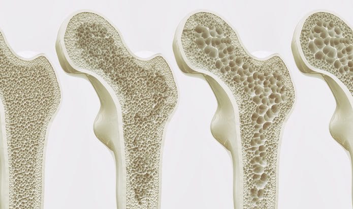 Ilustração dos diferentes estágios da osteoporose