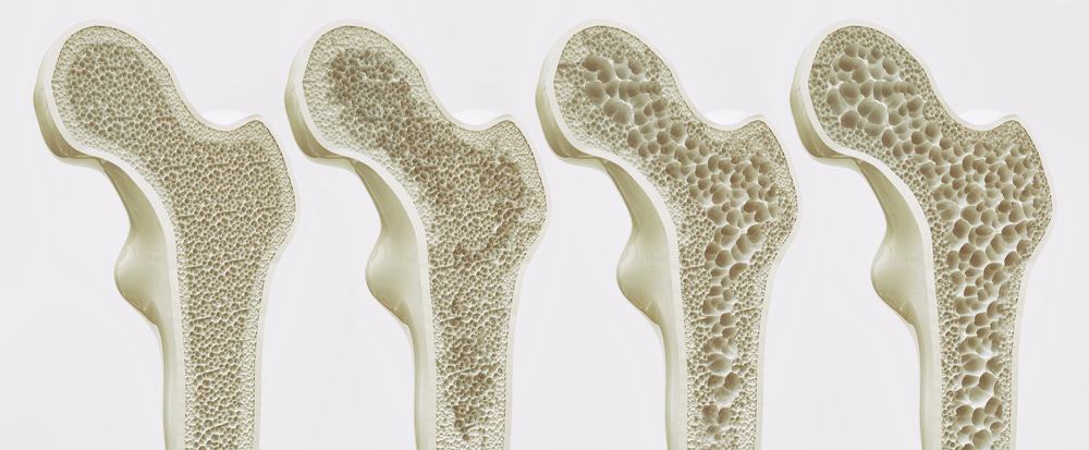 Ilustração dos diferentes estágios da osteoporose