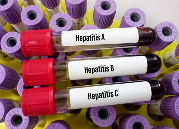 Vidros de laboratório com amostras de sangue infectado por hepatite