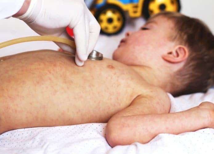 Criança infectada por sarampo sendo examinada por um médico