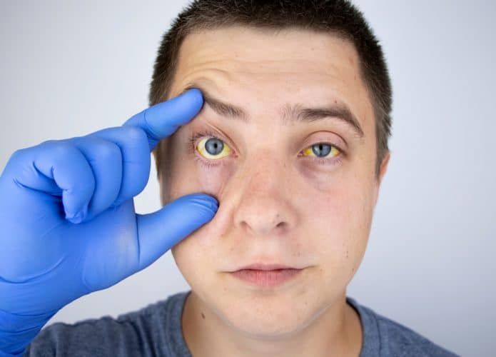 Homem mostrando os olhos amarelos