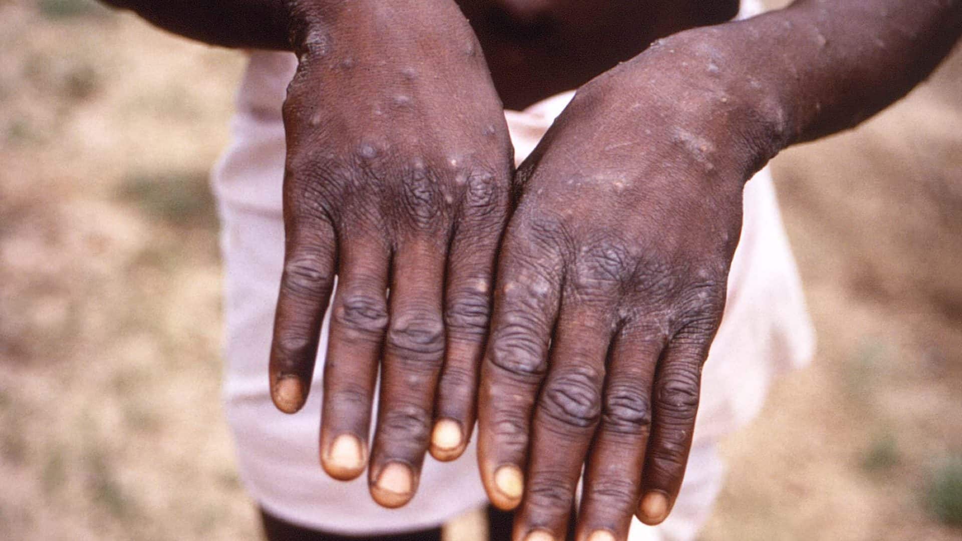 Mãos de homem com varíola