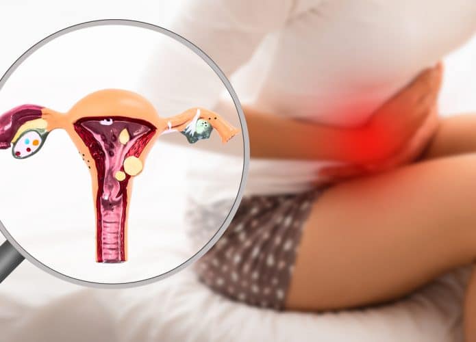Uma mulher sentido dores por causa da endometriose, com uma ilustração da doença, para remeter à cantora Anitta, que terá que fazer uma cirurgia