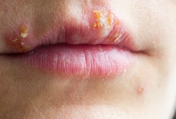 Herpes labial