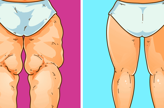 lipedema