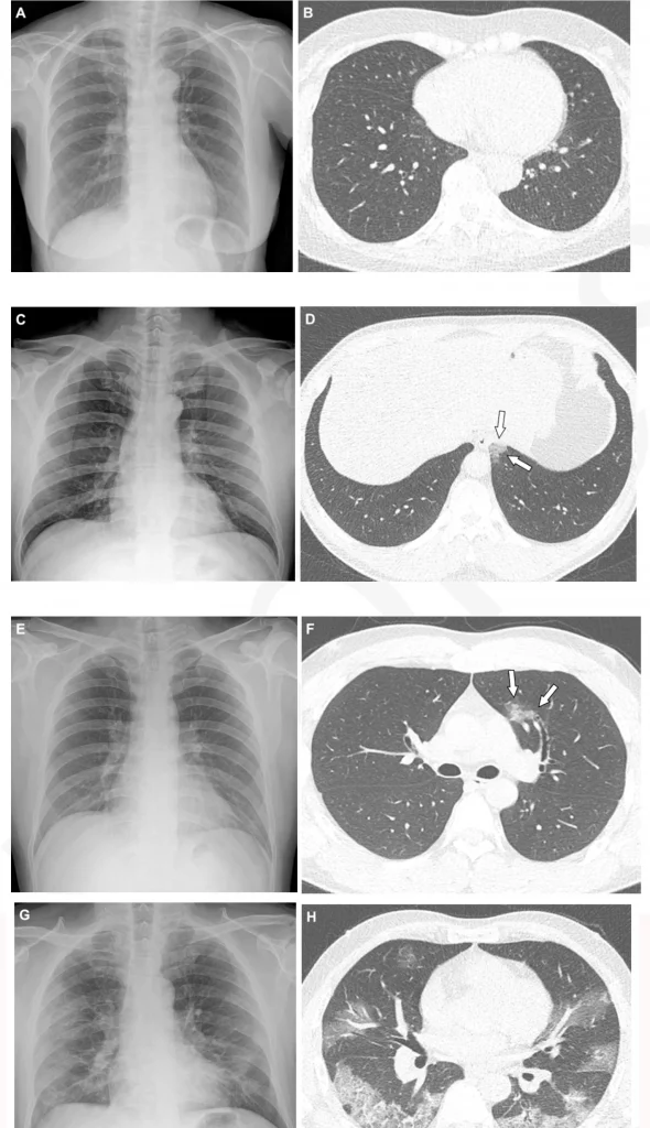 Tórax de homem de 36 anos que não foi vacinado contra a Covid-19 e sem comorbidades nas imagens E e F; o exame E foi realizado logo após a entrada no hospital com nenhuma alteração no pulmão; Já a tomografia F foi tirada no mesmo dia e mostra anomalia no lobo superior esquerdo (Foto: Yeon Joo Jeong et.al)