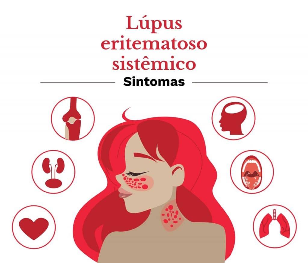 Sintomas Lúpus