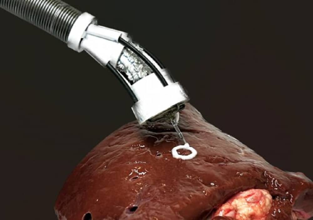 Robô permite bioimpressão 3D dentro do corpo humano; saiba mais