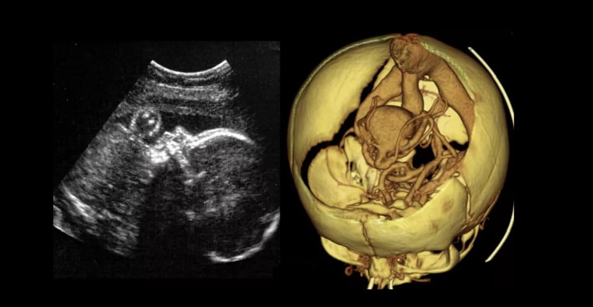 cirurgia-feto-cerebro