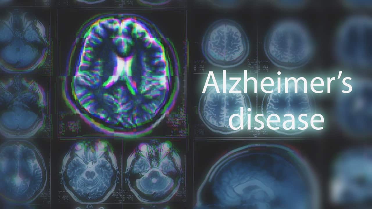 alzheimer