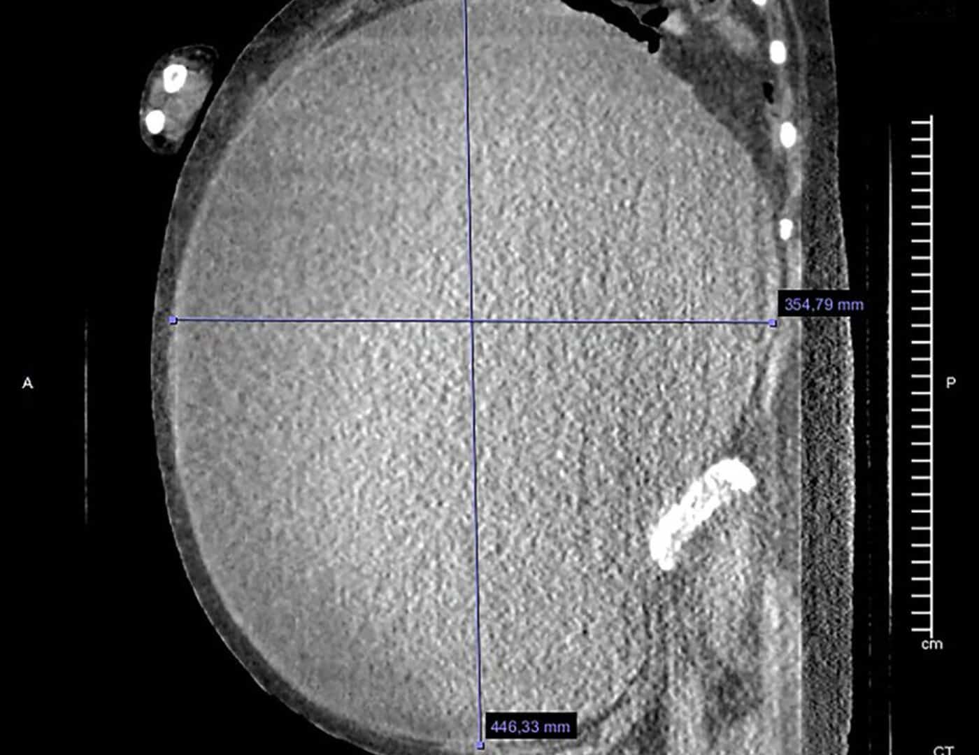 Cisto-tomografia-1-1400x1080
