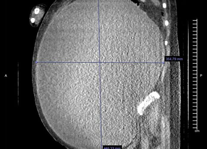 Cisto-tomografia-1-695x500