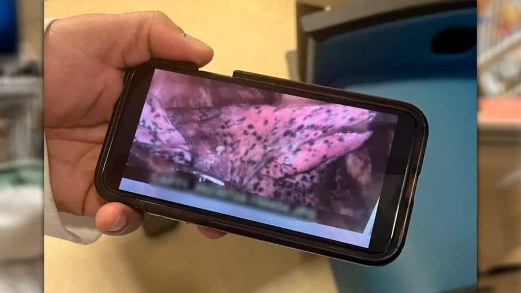 Pulmão de jovem após uso de vape