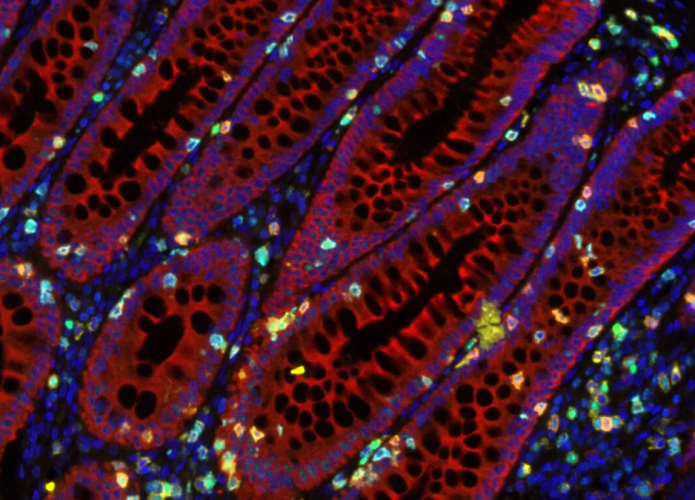 Cancer-de-Intestino-Celulas-T-695x500.png