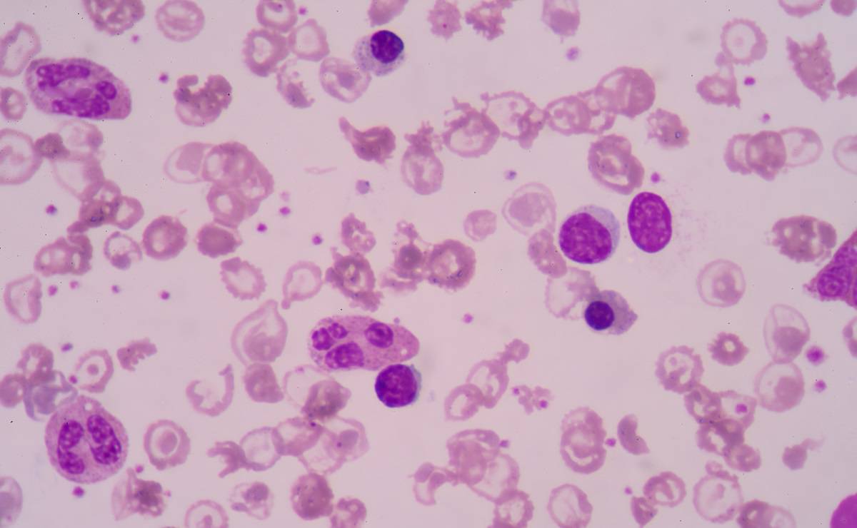 anemia_falciforme_2