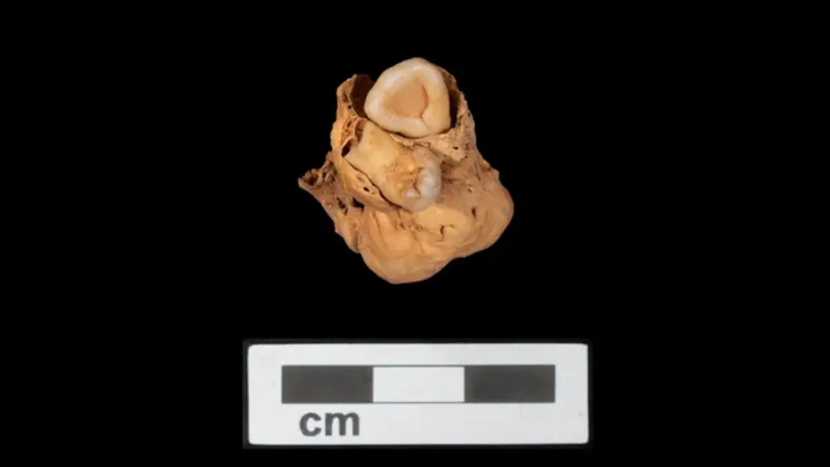 O tumor raro se trata de um teratoma (Crédito: Projeto A. Deblauwe/Amarna)