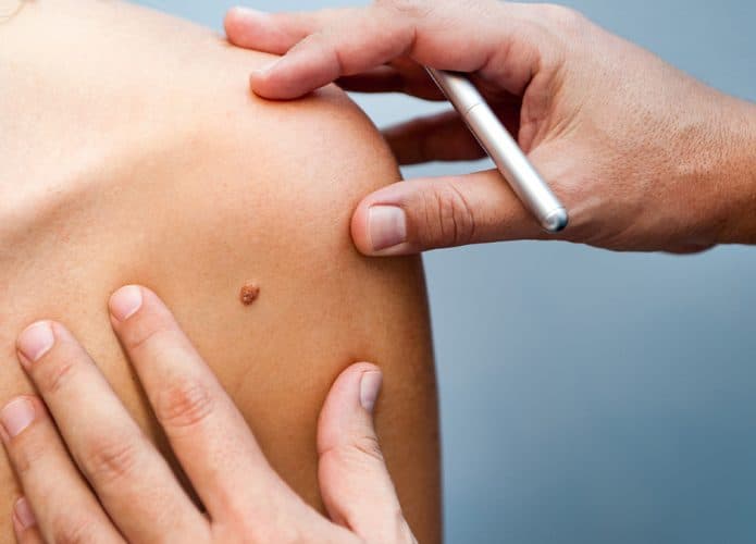 Médico examinando pinta que pode ser câncer de pele