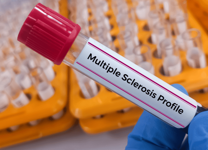 Esclerose-multipla-695x500.png