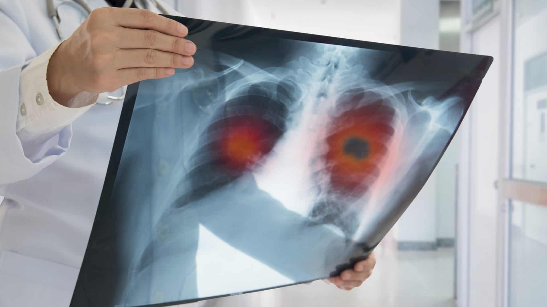 médico segura exame de imagem que mostra problema de saúde no pulmão