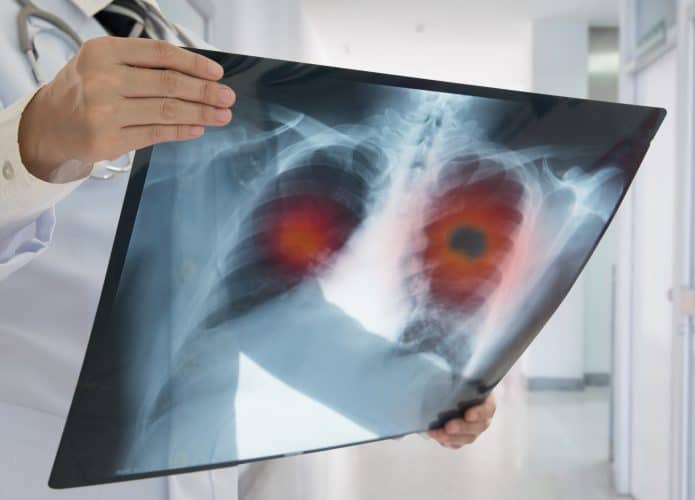 médico segura exame de imagem que mostra problema de saúde no pulmão