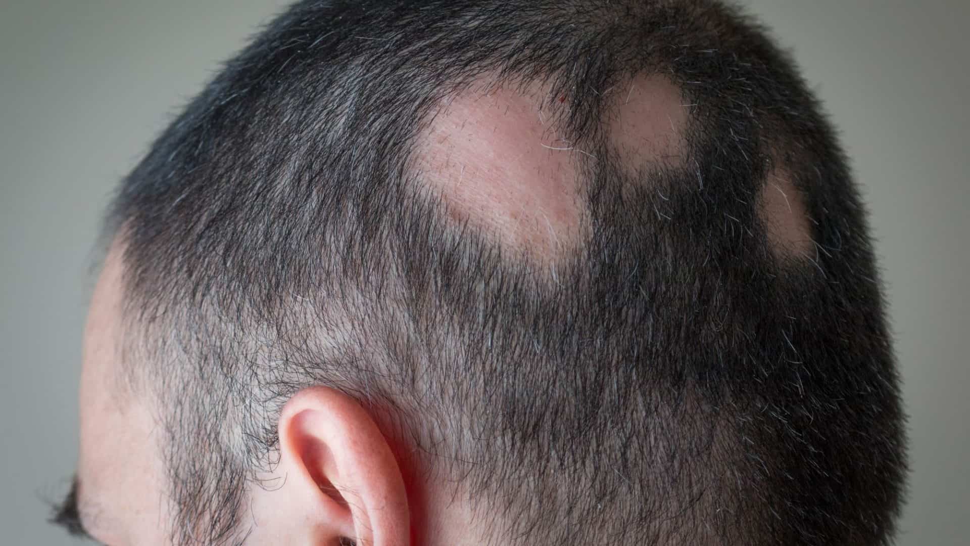 queda de cabelo