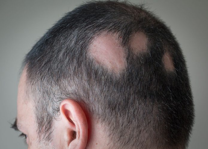 Tratamento promissor pode curar a calvície associada à alopecia