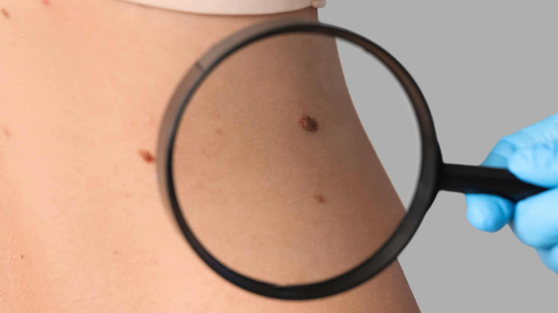 Pele sendo examinado à procura de câncer