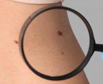 Pele sendo examinado à procura de câncer