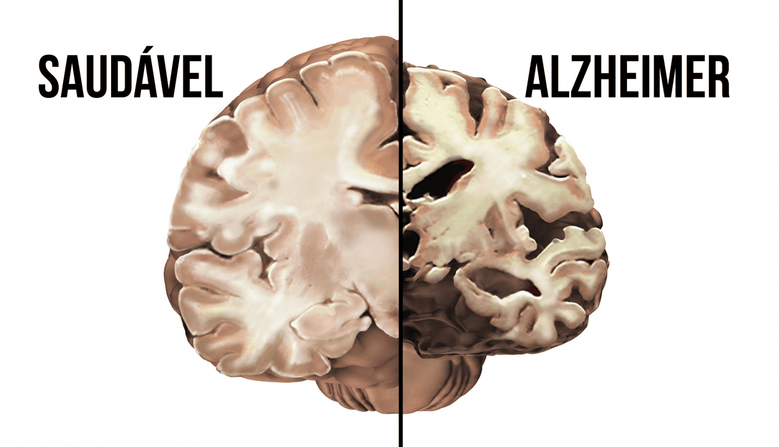 Como o Alzheimer afeta o corpo e o cérebro do ser humano?