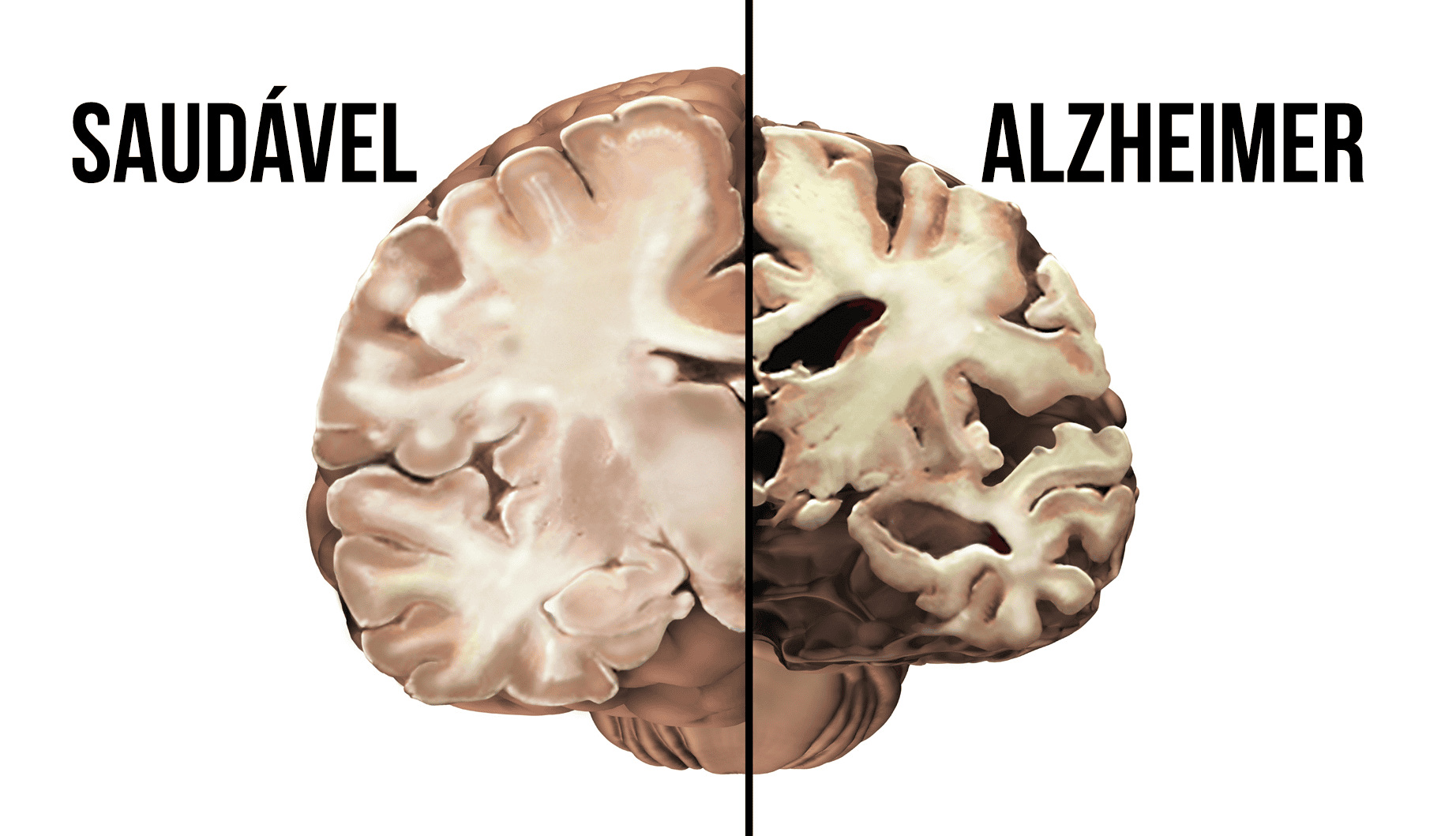Como o Alzheimer afeta o corpo e o cérebro do ser humano?