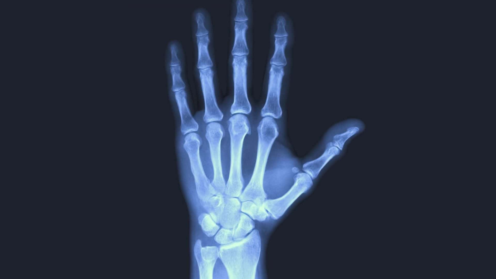 Imagem mostra a radiografia de uma mão humana: ossos dos dedos, mão e punho
