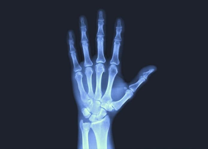 Imagem mostra a radiografia de uma mão humana: ossos dos dedos, mão e punho