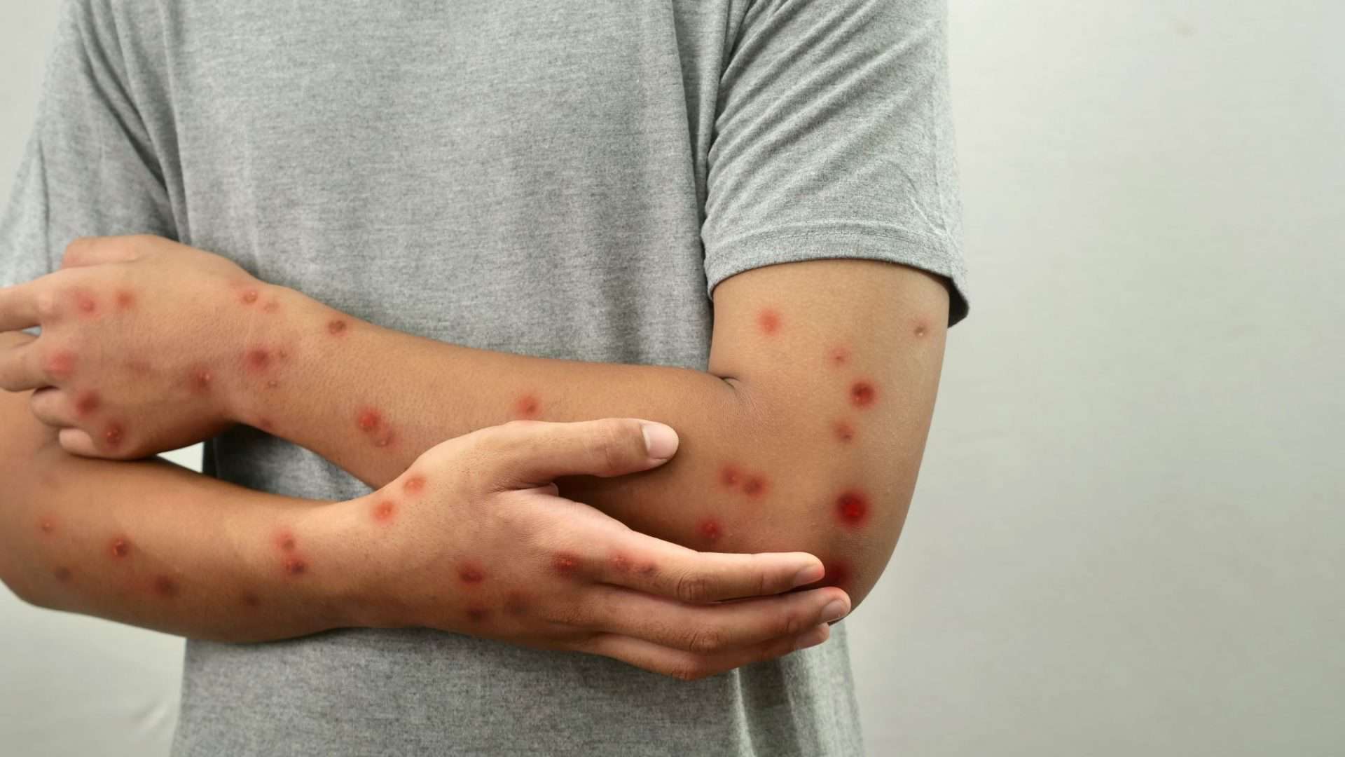 mpox