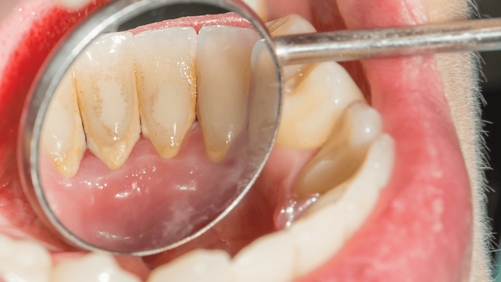 Placa-bacteriana-dentaria-1920x1080.png