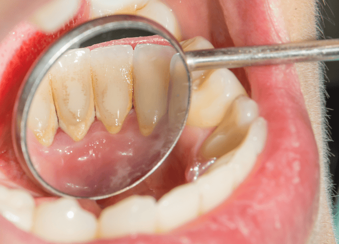 Placa-bacteriana-dentaria-695x500.png