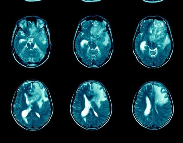 ressonância magnética do cérebro mostra tumor