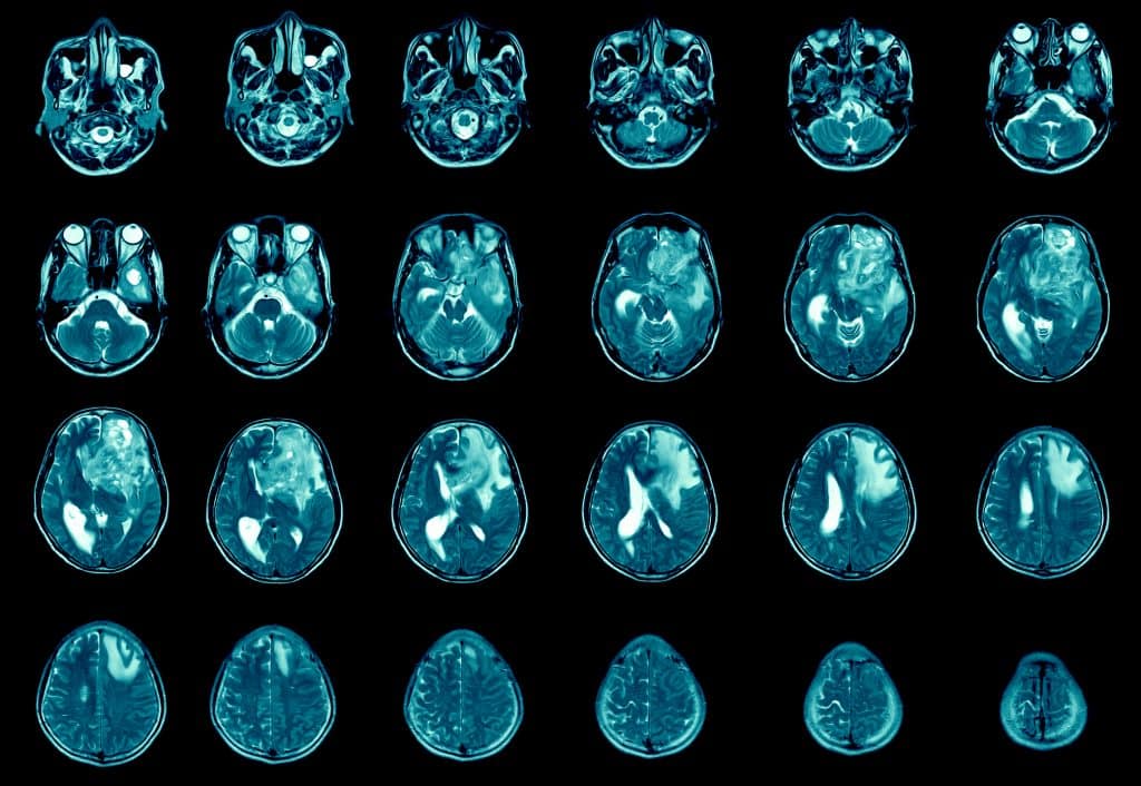ressonância magnética do cérebro mostra tumor